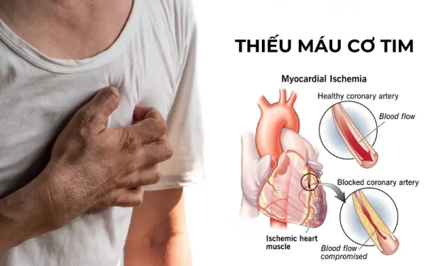 Phát hiện thiếu máu cơ tim