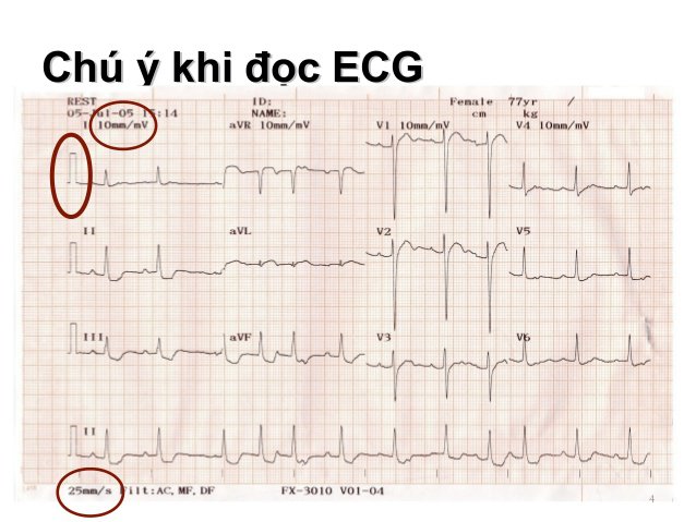 Máy đo điện tâm đồ và vai trò quan trọng trong chẩn đoán bệnh lý tim mạch