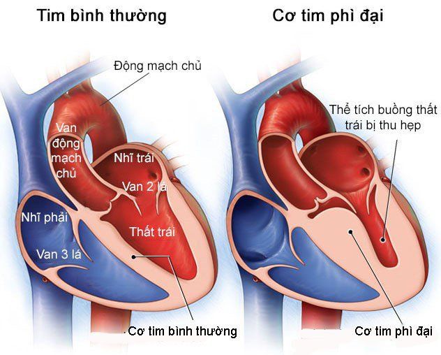 Phát hiện phì đại buồng tim