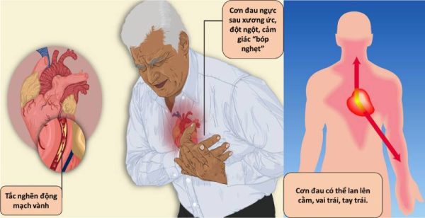 Phát hiện nhồi máu cơ tim